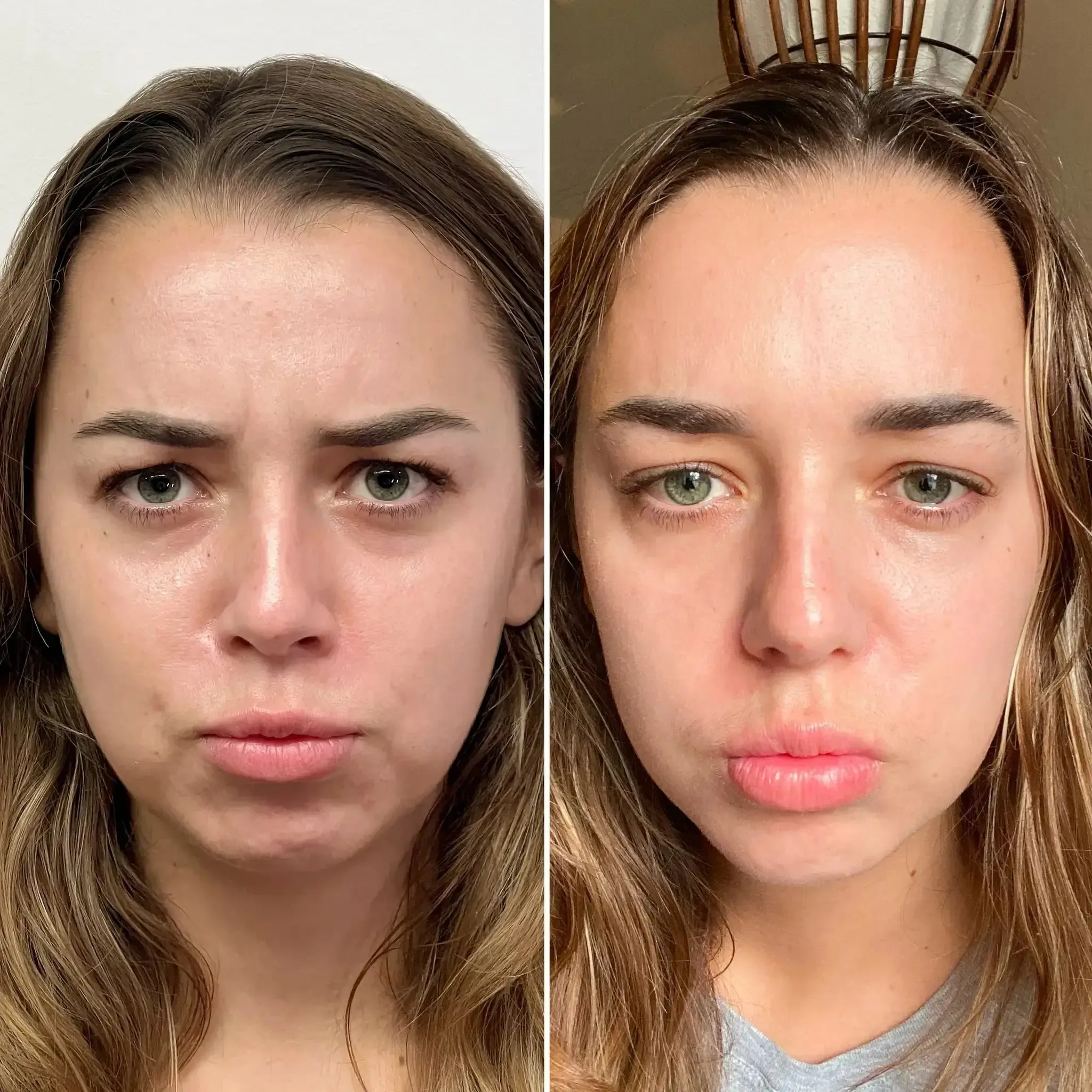 WrinkleFix: Unlimited Toxins Membership