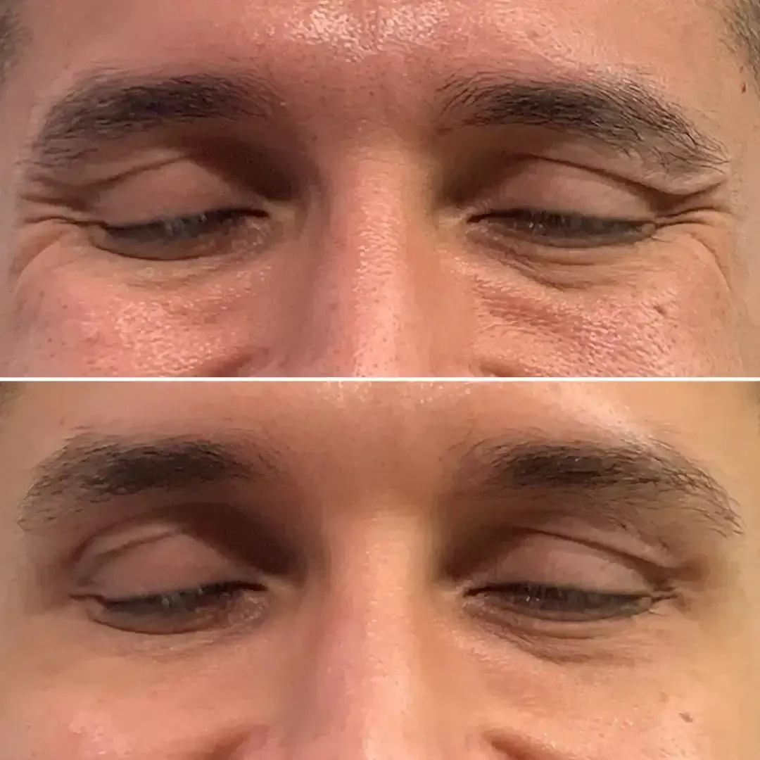 WrinkleFix: Unlimited Toxins Membership