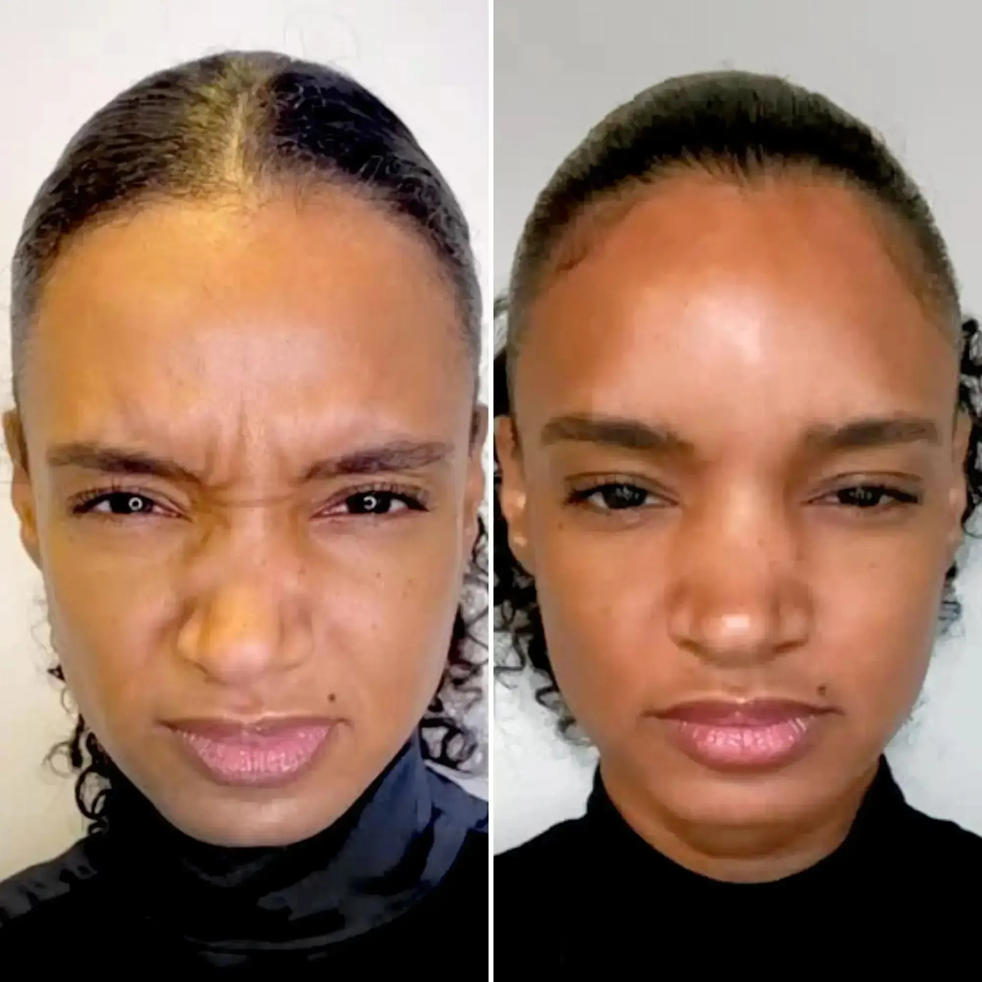 WrinkleFix: Unlimited Toxins Membership