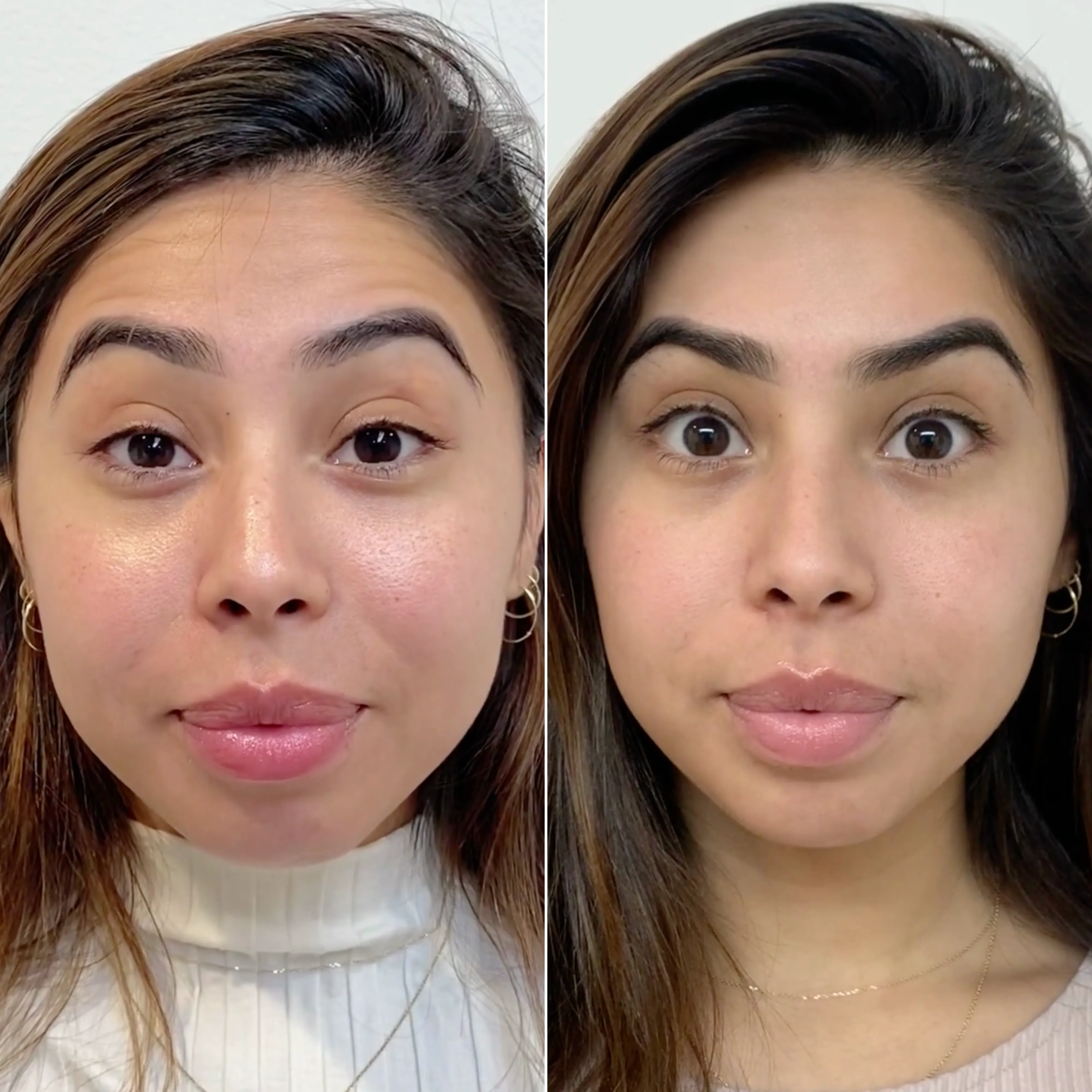 WrinkleFix: Unlimited Toxins Membership